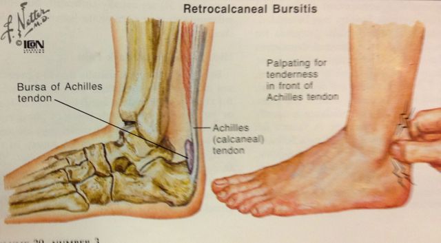 conrad-stoltz-caveman-retrocalcaneal-bursitis